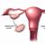 Behandling av polycystiskt ovariesyndrom
